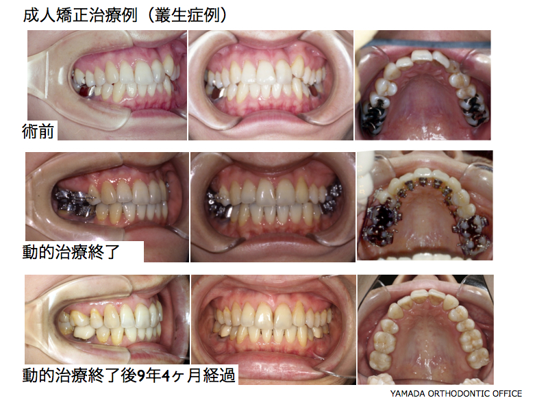 成人矯正治療例（叢生症例）舌側矯正治療例 | ヤマダ矯正歯科院長のブログ