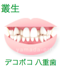 交叉咬合 歯の中心が左右にずれている の症例を大阪のヤマダ矯正歯科のビフォーアフターで紹介